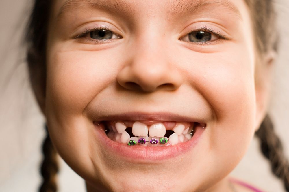 6 (ortodonzia infantile)
