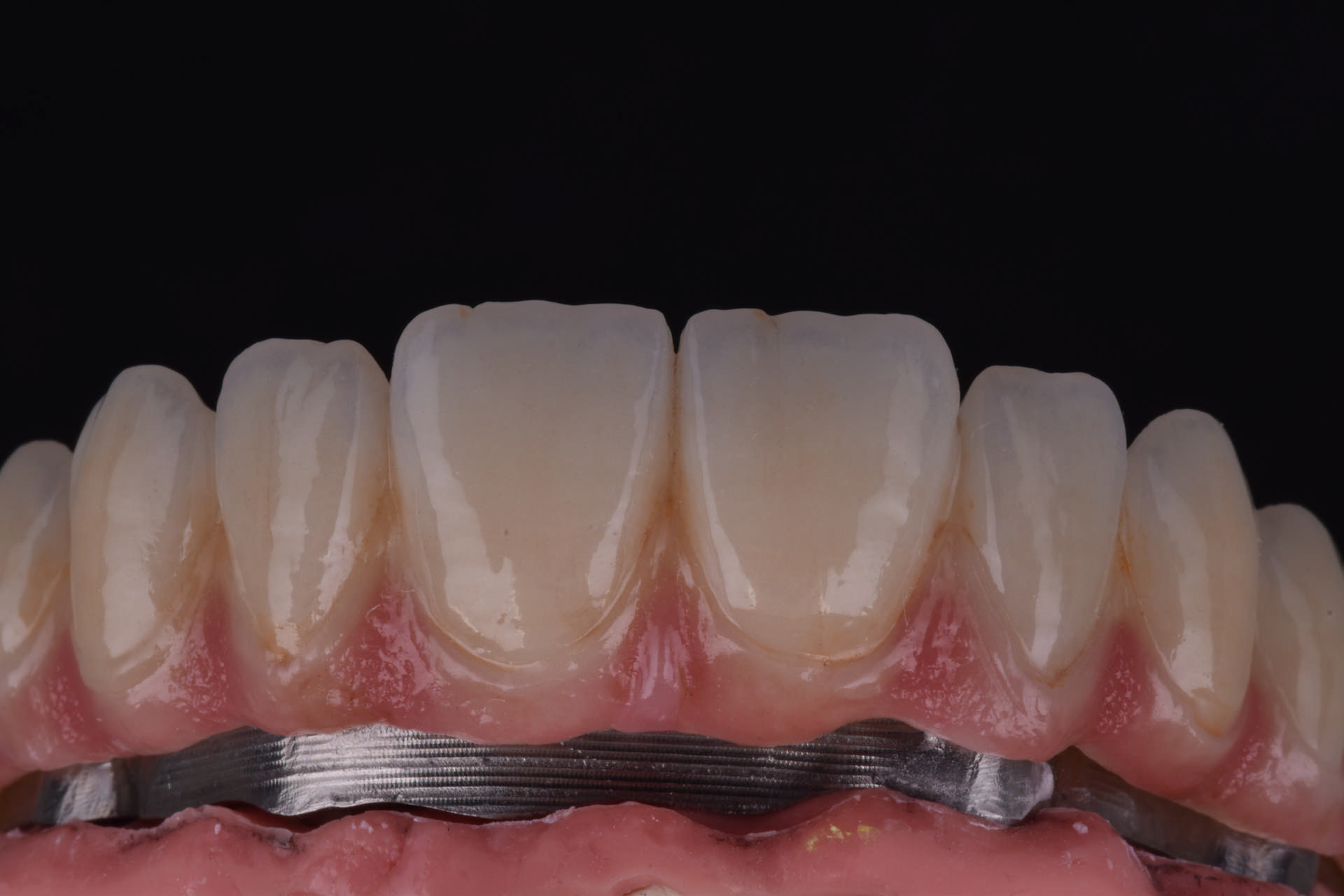 6 (protesi overdenture)